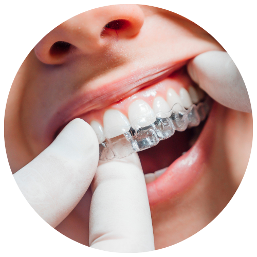 close up of a patient getting invisalign trays inserted