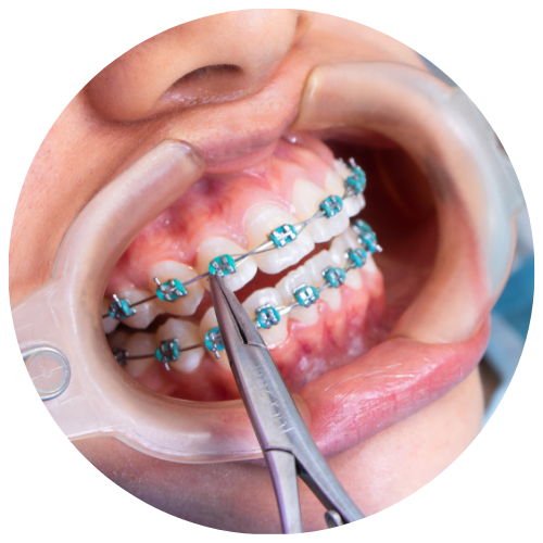 close up of traditional metal braces with colored elastics
