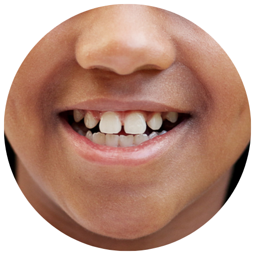 girl with protruding "buck" teeth in need of orthodontics