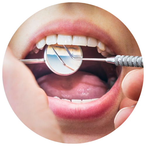 open mouth showing bonded permanent retainer on interior of upper teeth