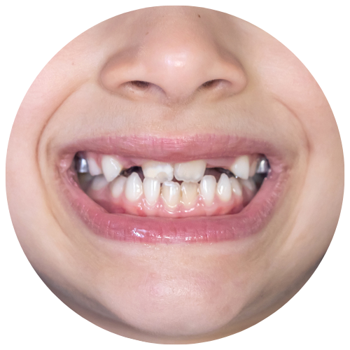 girl with cross bite in need of orthodontic intervention