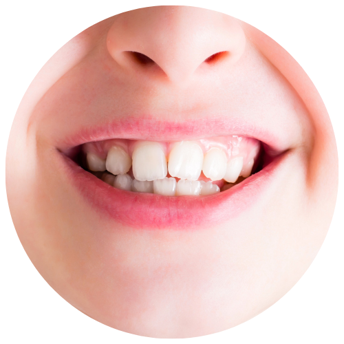 child with very crowded teeth in need of braces