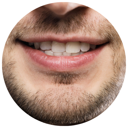 man with misaligned midline who will be starting invisalign to correct the issue