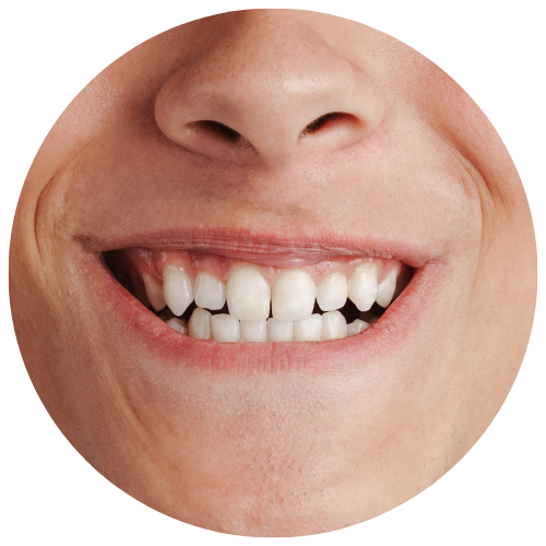 teen with an open bite who would benefit from orthodontics to protect his smile