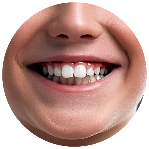 tween boy with an overbite, a common orthodontic problem, needing braces in the bay area