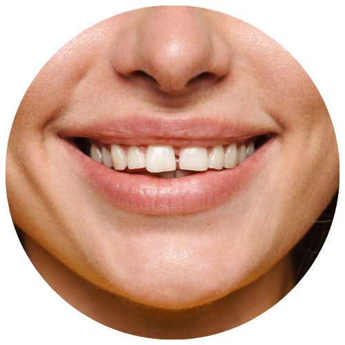 woman with spacing issues who could benefit from orthodontics