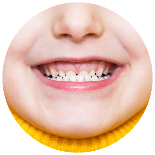 little girl with underbite in need of orthodontics