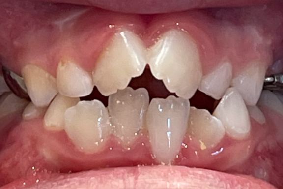 crowded teeth showing your teen may need braces