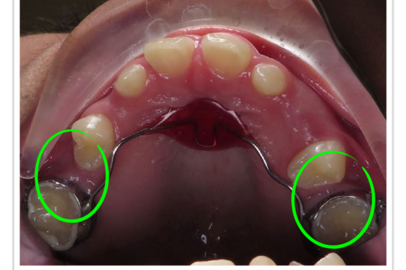space loss showing your teen may need braces