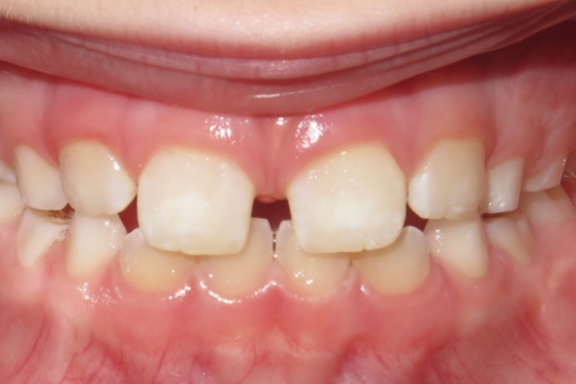 spaced teeth showing your teen may need braces