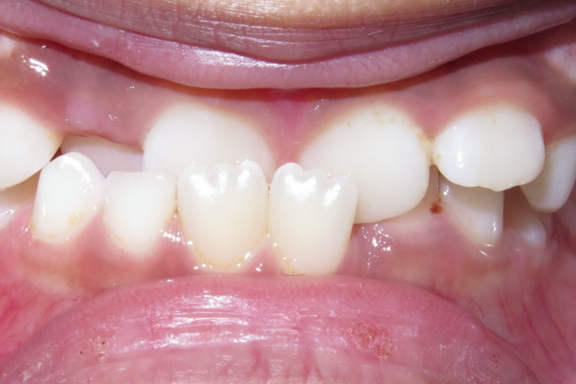 underbite showing your kids may need braces