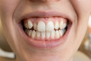 close up of teeth that are crowded answering the question "can Invisalign fix crowded teeth?"