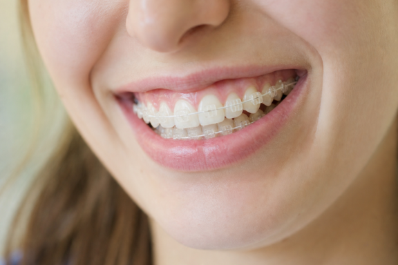 'Ceramic braces on adult patient at Aubrey Barrett Orthodontics'